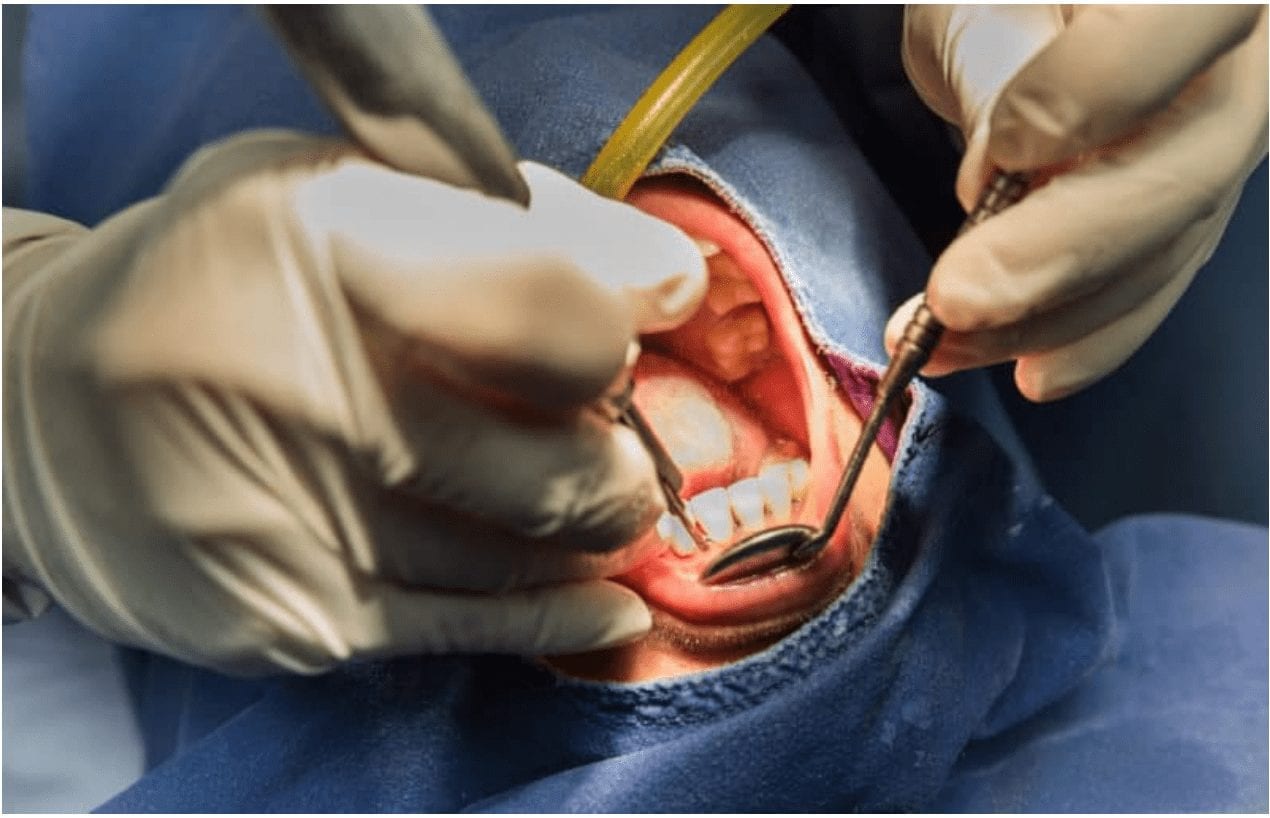 Endodontic Endotoxemia: The Oral-Systemic Connection