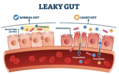 Leaky Gut 101