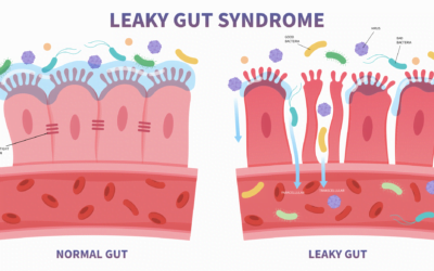 What Causes Leaky Gut