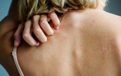 Gut Bacteria and HIstamine